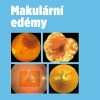 Makulární edémy